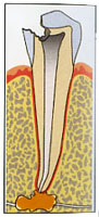 虫歯の進行状況4